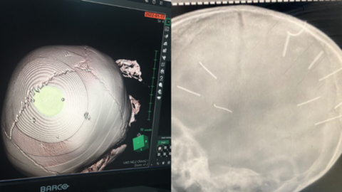 Vụ bé 3 tuổi bị nhân tình của mẹ đóng đinh ở đầu: Đáp ứng điều trị kém, tiên lượng dè dặt