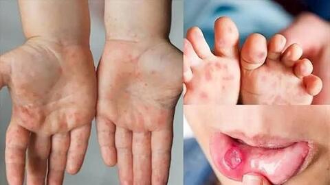 Trên 3.000 ca tay chân miệng mỗi tuần, nguy cơ gia tăng khi trẻ vào năm học mới